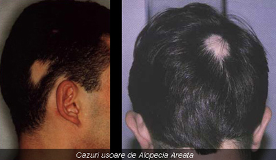 Alopecia areata Alopecia areata