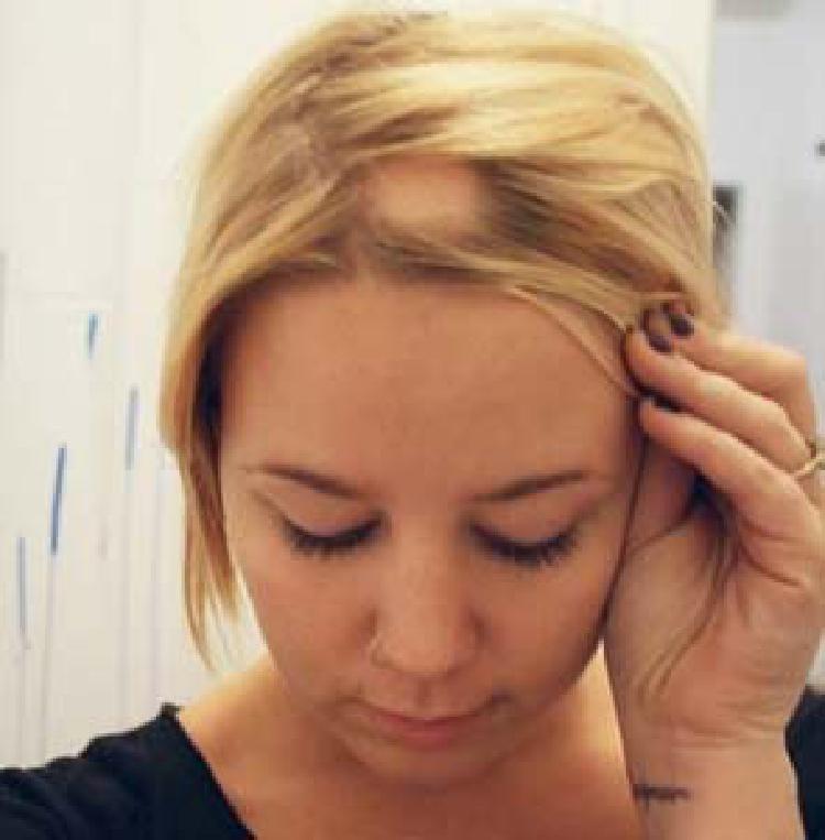 Alopecia Areata