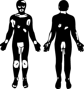 Dispunere frecventa a petelor de vitiligo Dispunere frecventa a petelor de vitiligo