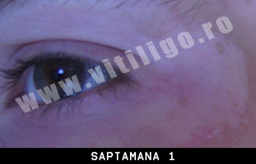repigmentare vitiligo