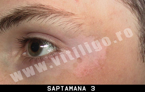 repigmentare vitiligo
