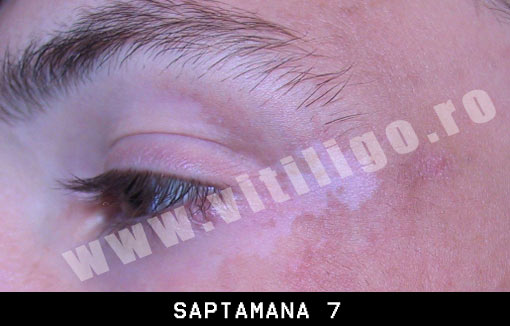 repigmentare vitiligo