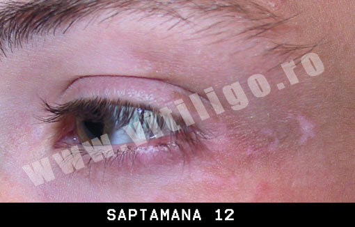 repigmentare vitiligo