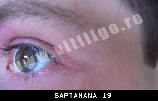 repigmentare vitiligo