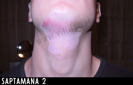 repigmentare vitiligo