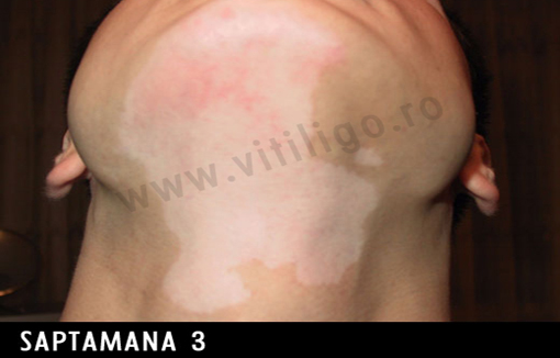 repigmentare vitiligo