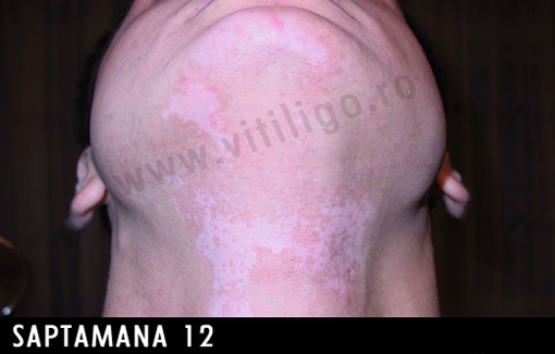 repigmentare vitiligo