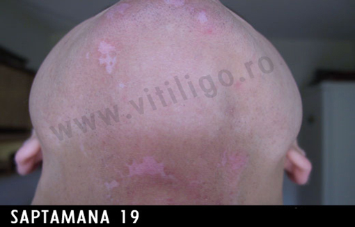 repigmentare vitiligo