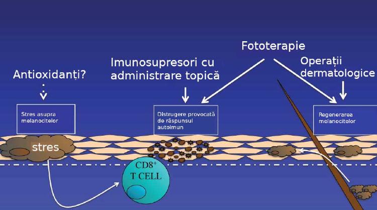 Ce tratamente pentru vitiligo își pot face apariția în viitor?