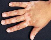 Ce este vitiligo?
