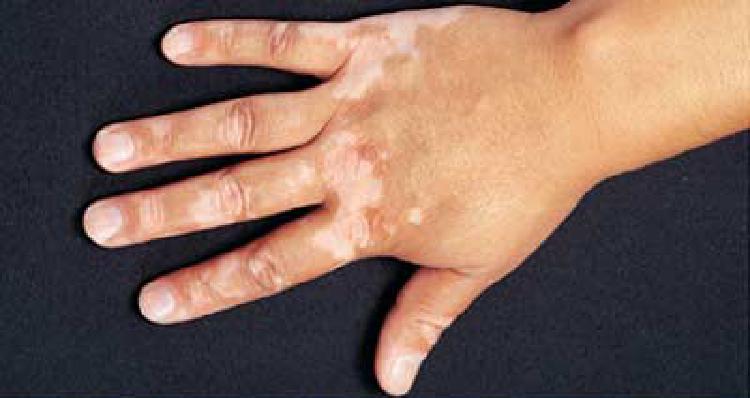 Ce este vitiligo?