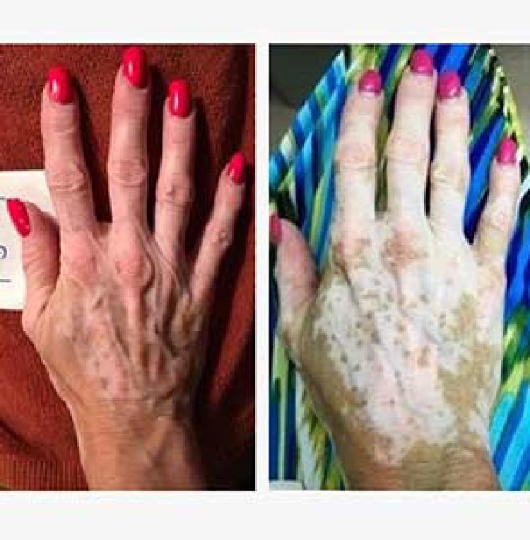 Ajută medicamente pentru psoriazis și artrită psoriazică în tratamentul vitiligo?