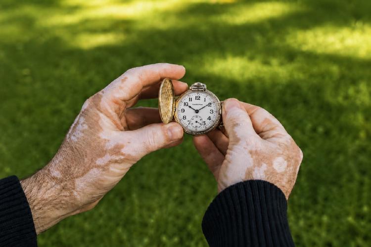 Vitiligo, o urgență terapeutică: de ce primii doi ani contează cel mai mult