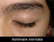 Care sunt tratamentele actuale pentru vitiligo?