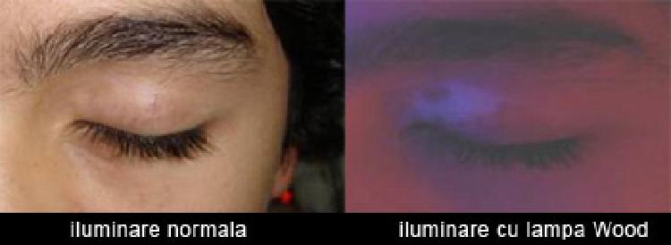 Care sunt tratamentele actuale pentru vitiligo?