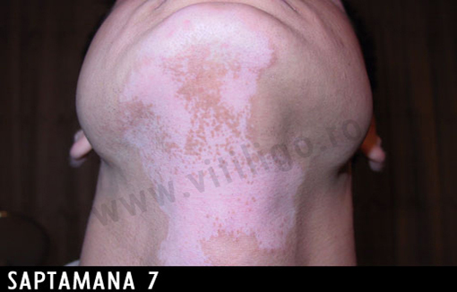 repigmentare vitiligo