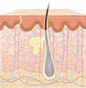 bronzare vitiligo