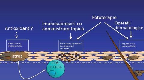 Axele principale în terapia vitiligo